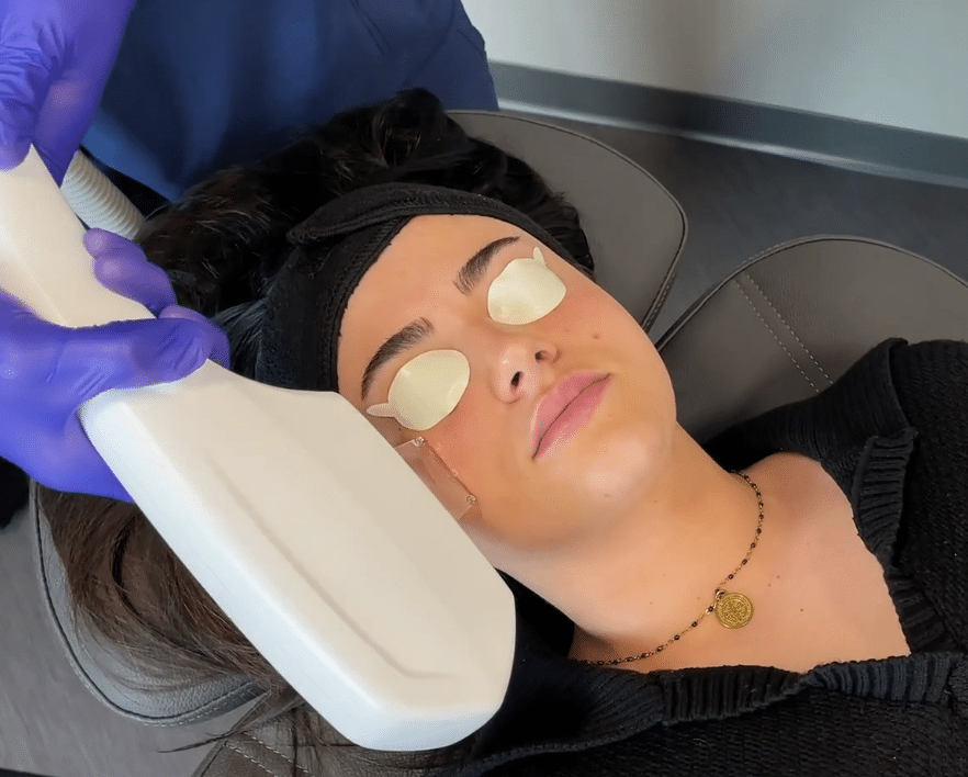 IPL dry eye therapy at Capital Vision Care